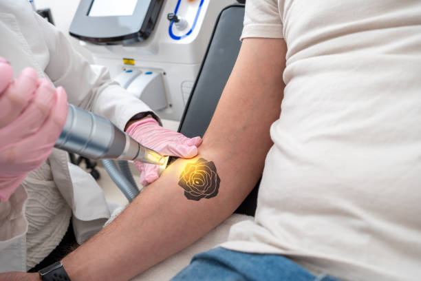 tattoo removal